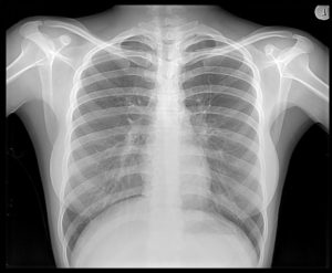image radiographie poitrine
